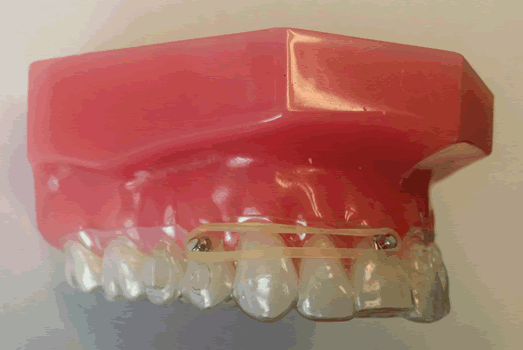 Rotations - How to Rotate Teeth with Auxiliaries