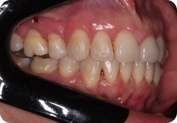 Extractions and Clear Aligners