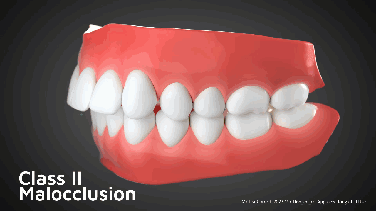 Bite Classifications