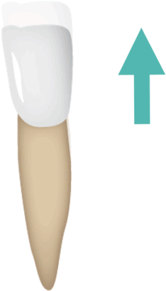 Tooth Movements