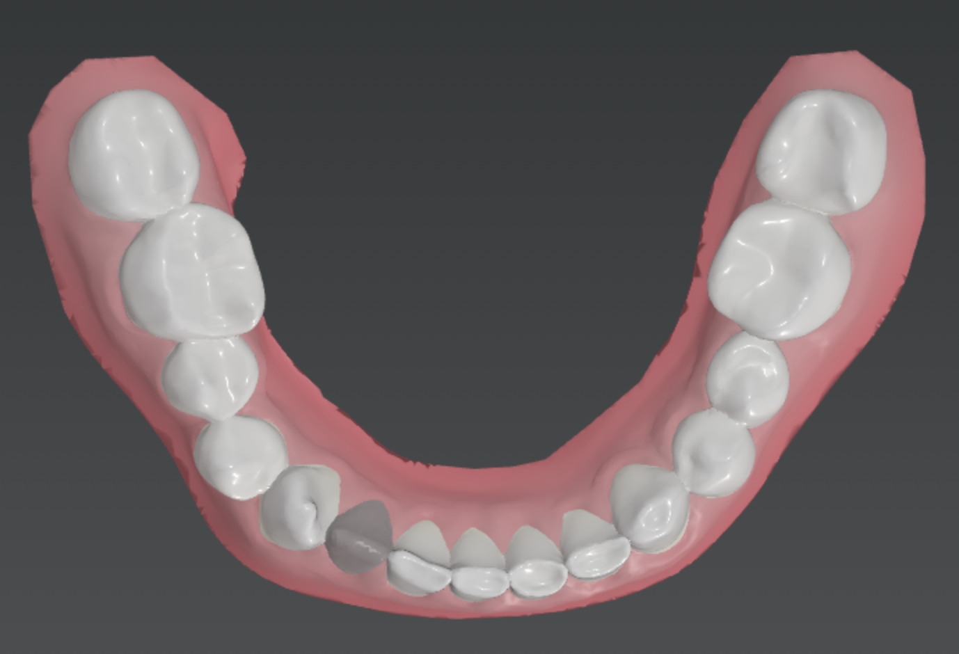 Extractions and Clear Aligners