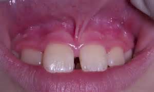 labial frenulum tear