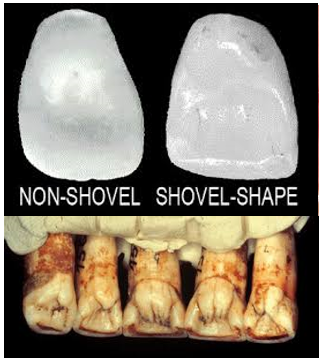 shovel_shaped_teeth.PNG