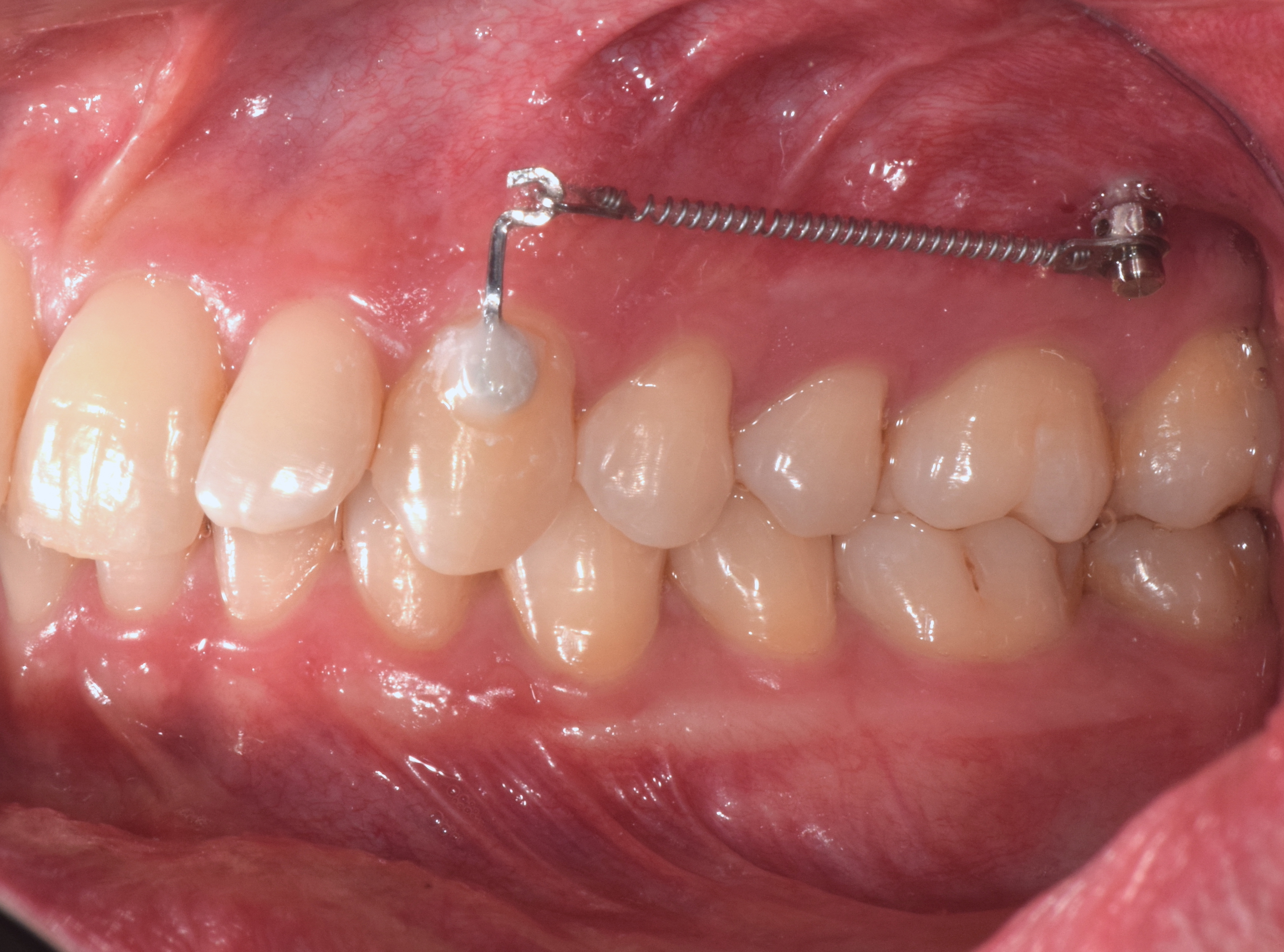 Intermaxillary Elastics with Clear Aligners: Types & Use