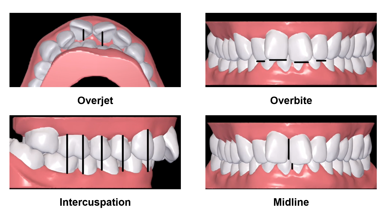 Treatment_setup_-_intercuspation_overjet_overbite_midline.PNG