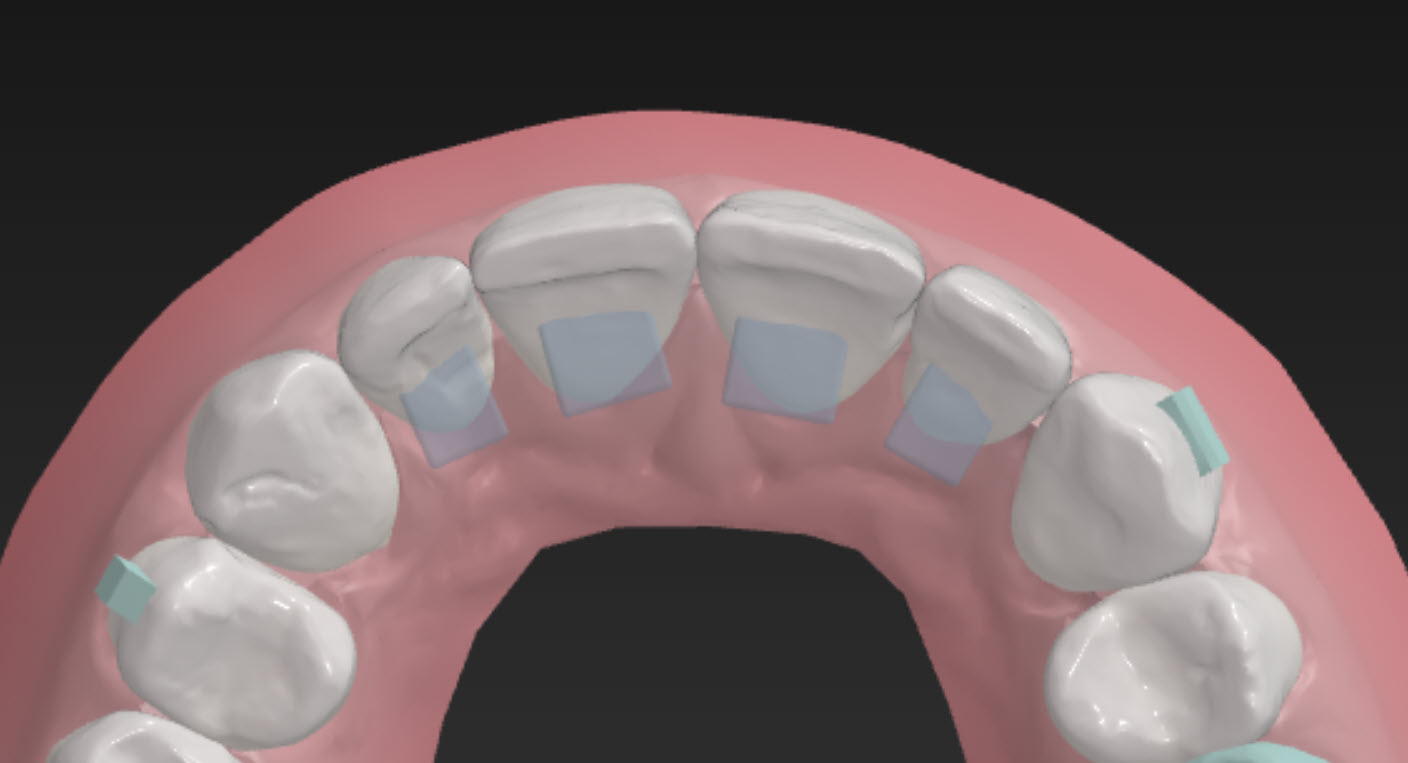 Bite Ramps ClearCorrect Support