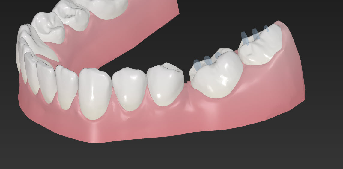 Bite Ramps ClearCorrect Support