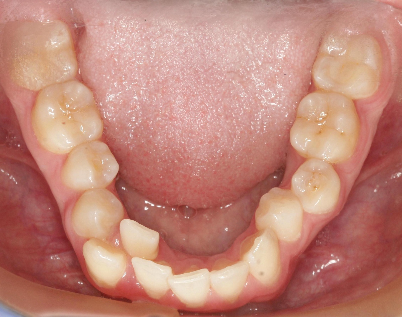 10 strumenti di rimozione dell'allineatore, strumenti di rimozione della  staffa ortodontico per la rimozione dei denti delle parentesi graffe  invisibili : : Salute e cura della persona