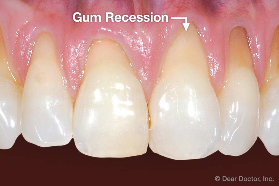 gum-recession.jpg