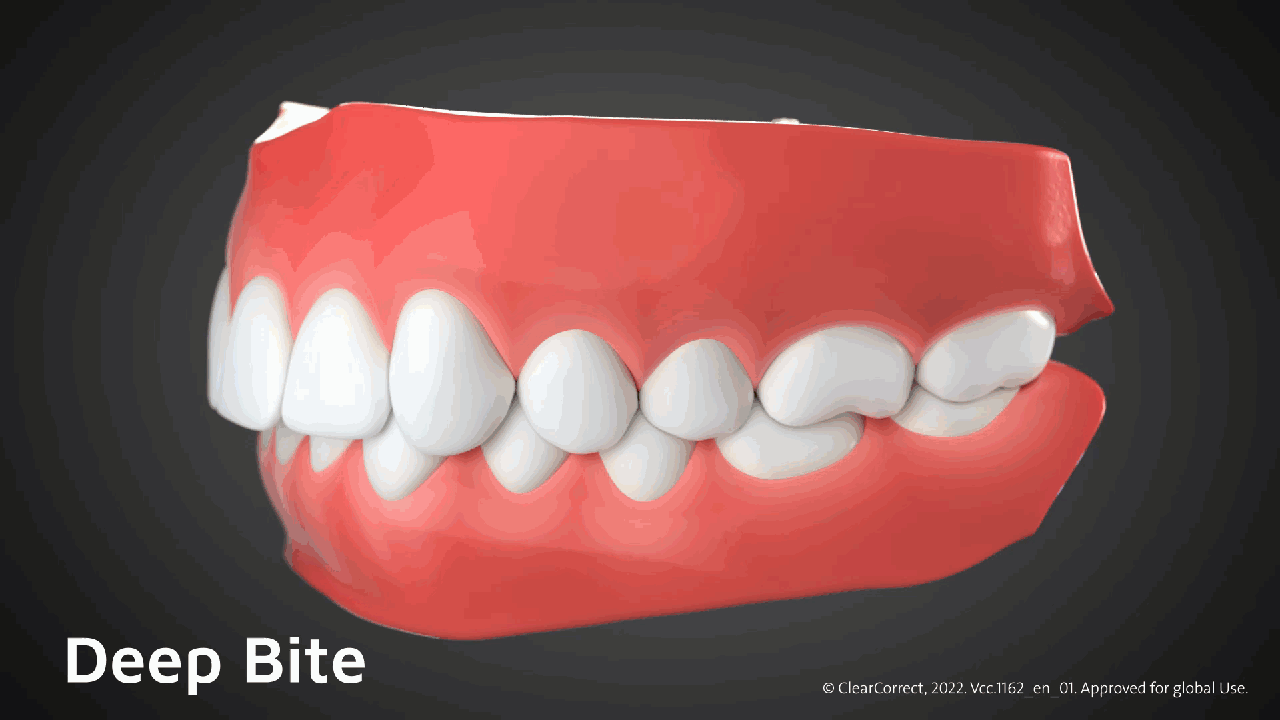 Vcc.1162_en_01_DeepBite.gif