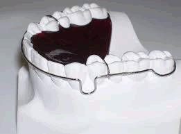 Wrap_around_retainer.gif