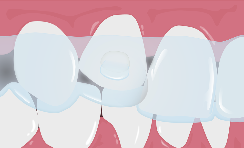 Incisal_gaps.png