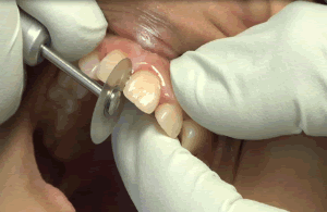 213781857_0.2mm_Step2.gif