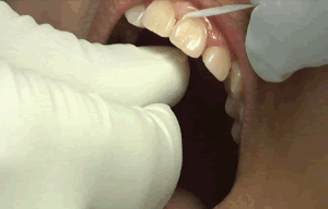 213781857_0.2mm_Step3.gif