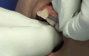 213781857_0.2mm_Step4.gif