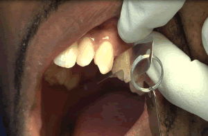 213781857_Posterior_0.2mm_Step4.gif