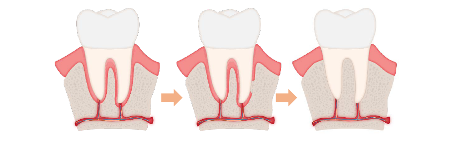 ankylosed_tooth_2.PNG
