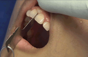 213781857_0.2mm_Step5.gif