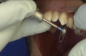 213781857_Posterior_0.2mm_Step2.gif