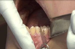 213781857_Posterior_0.3mm_Step3.gif