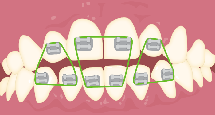 anterior_open_bite_aux.png