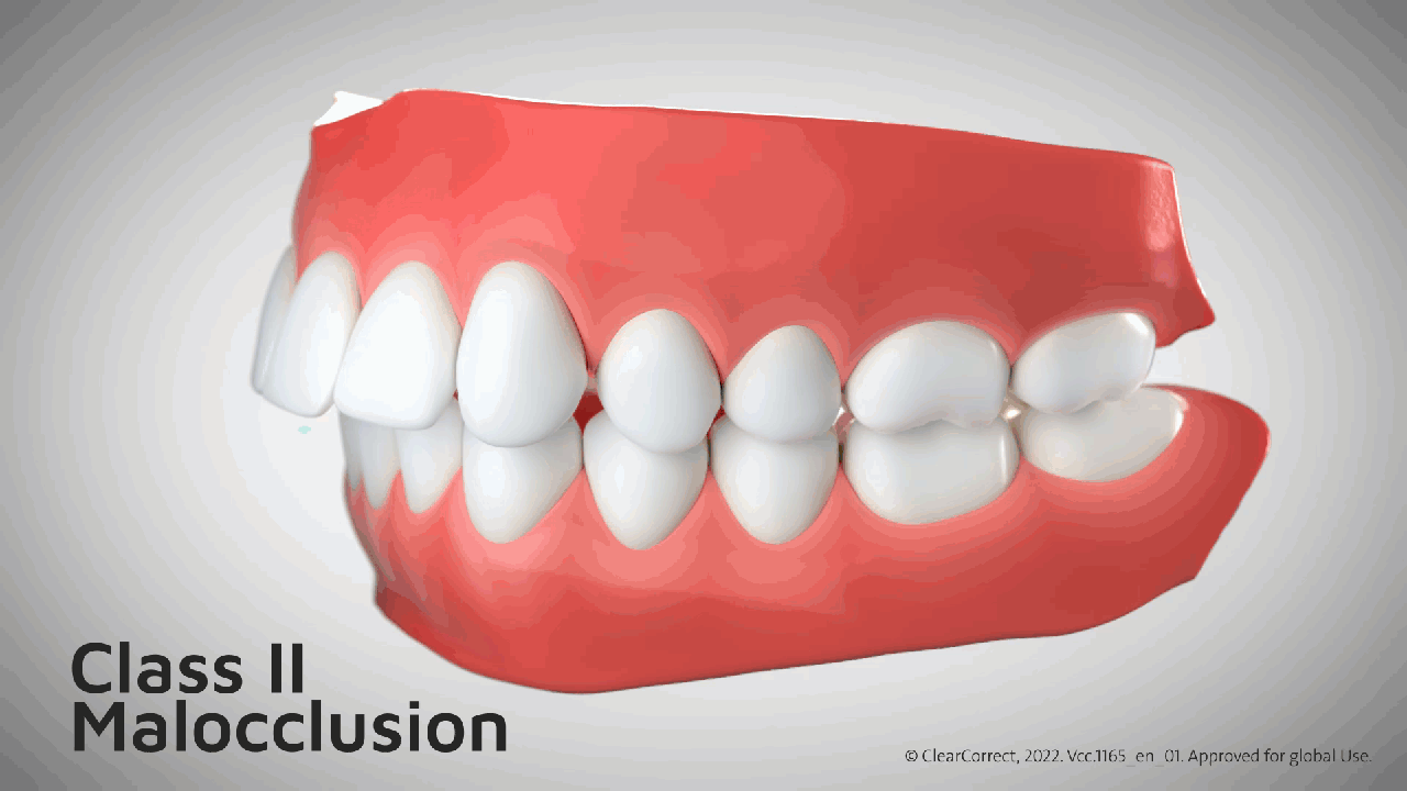 Class II Animation.gif
