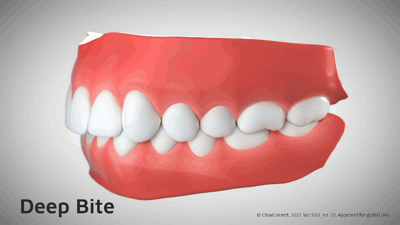 Deep bite 3D animation.gif