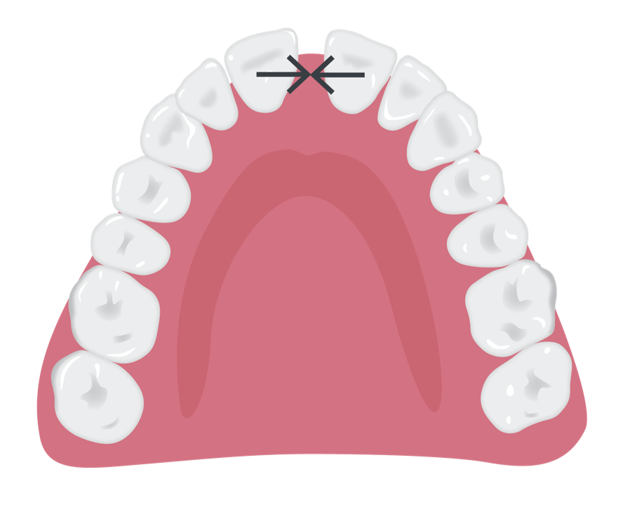 Translational_closure_of_small_spaces.png
