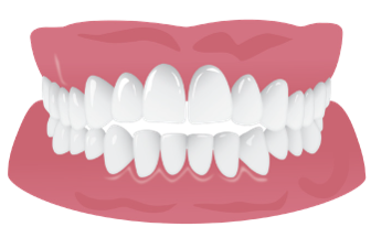 anterior_open_bite_corrections.png