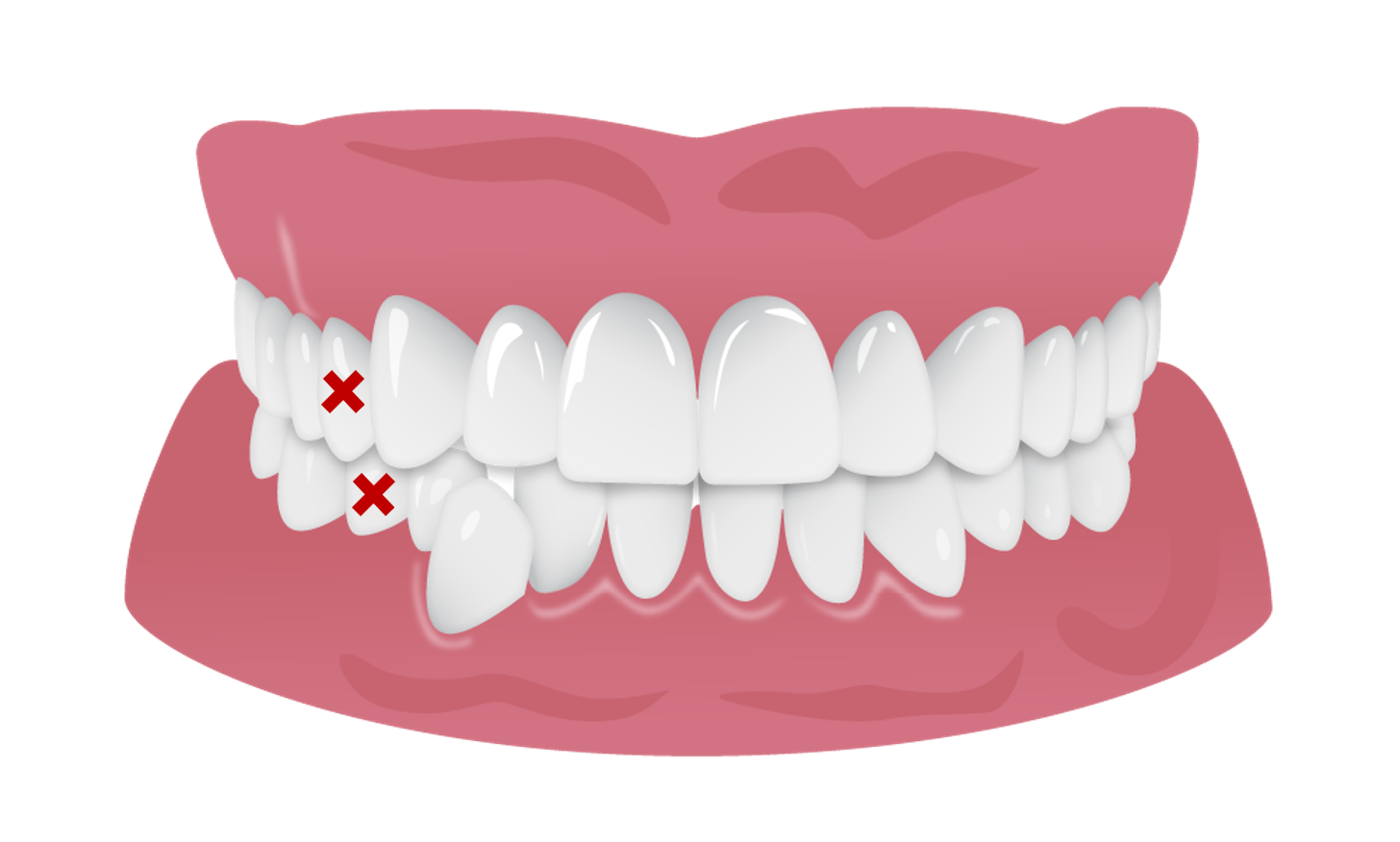 RX_extractions.png