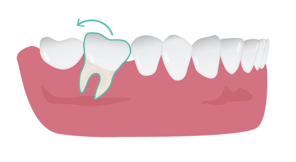 uprighting_molar_2.png