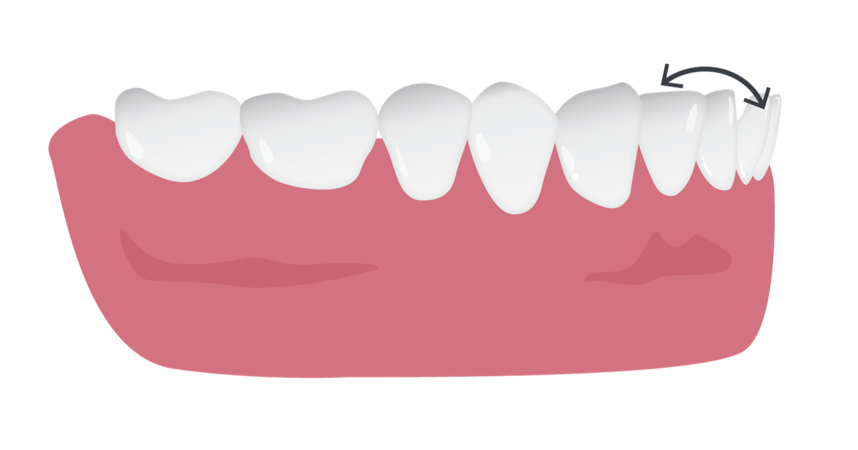 labial_lingual_crown_tipping.png