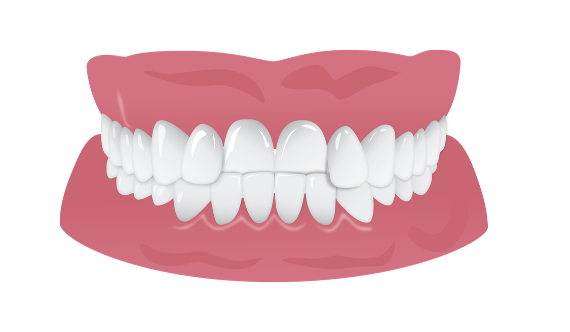 crossbite_-_small_borders.png