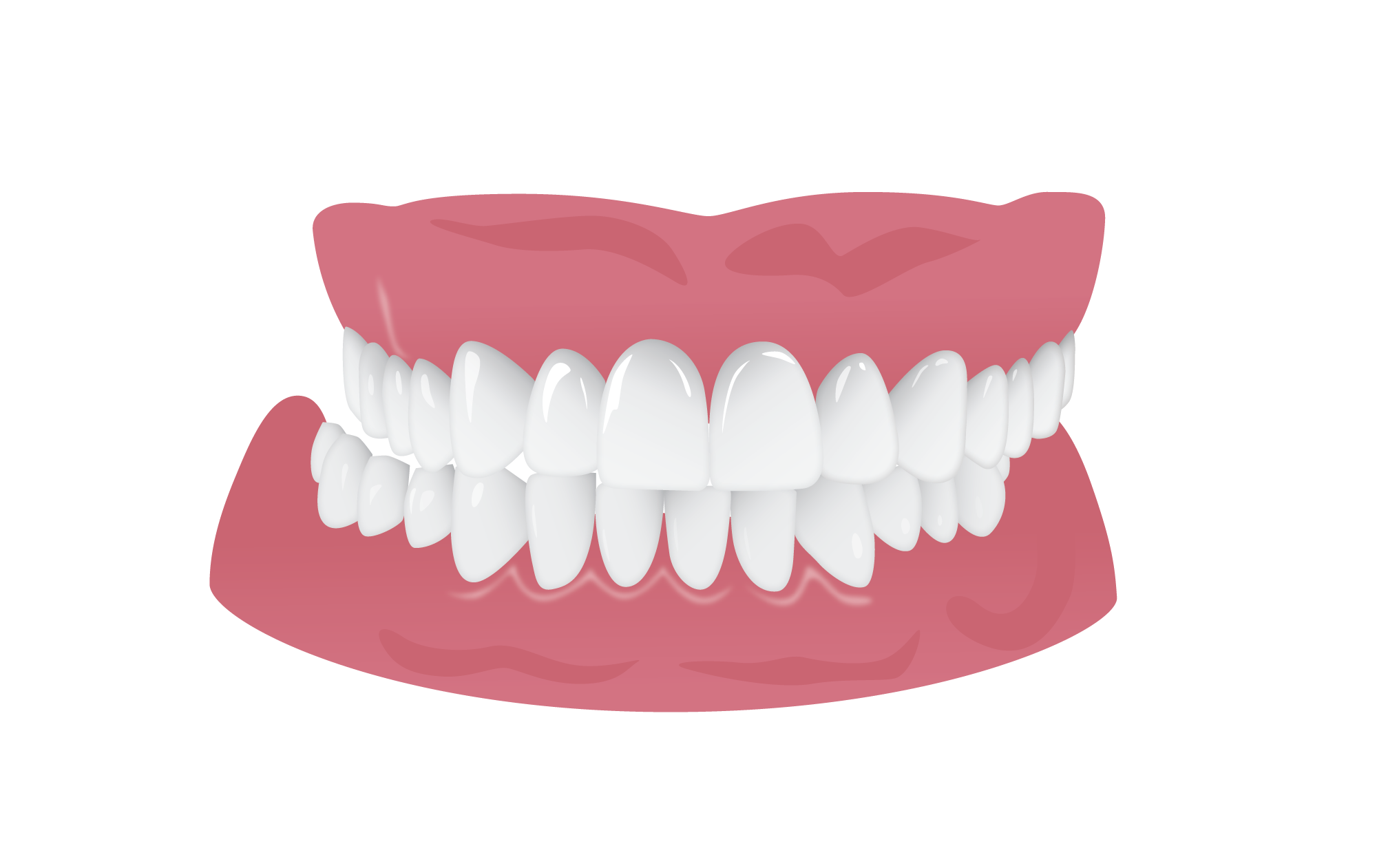 Posterior_Crossbite.png