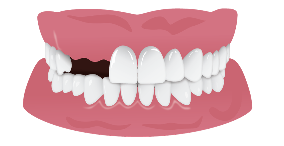 Span_of_missing_teeth_2.png