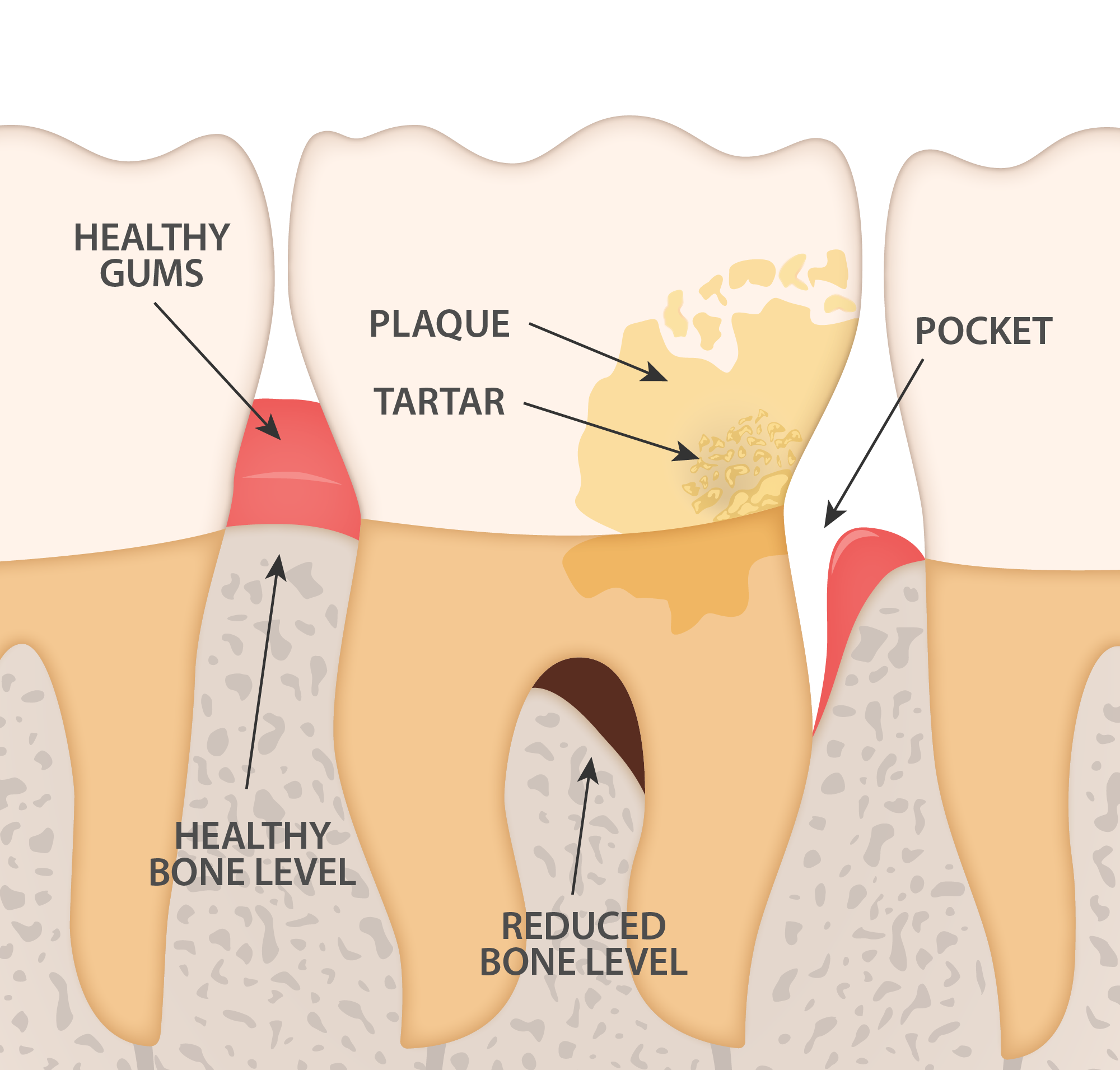 Periodontal_disease.png