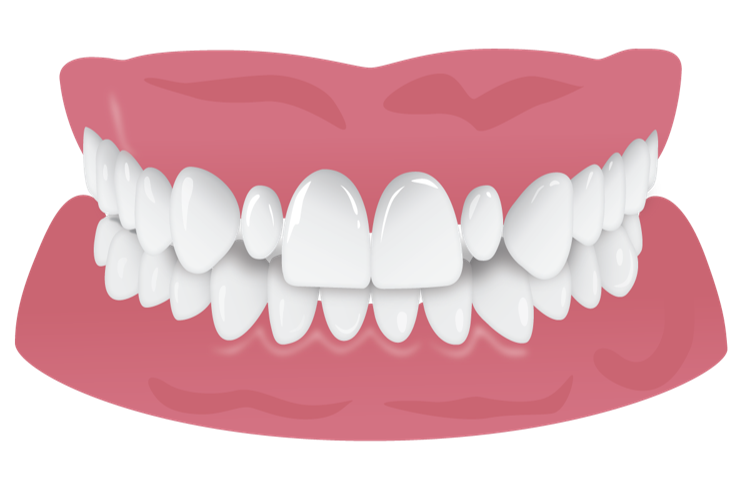 peg_laterals_4.png