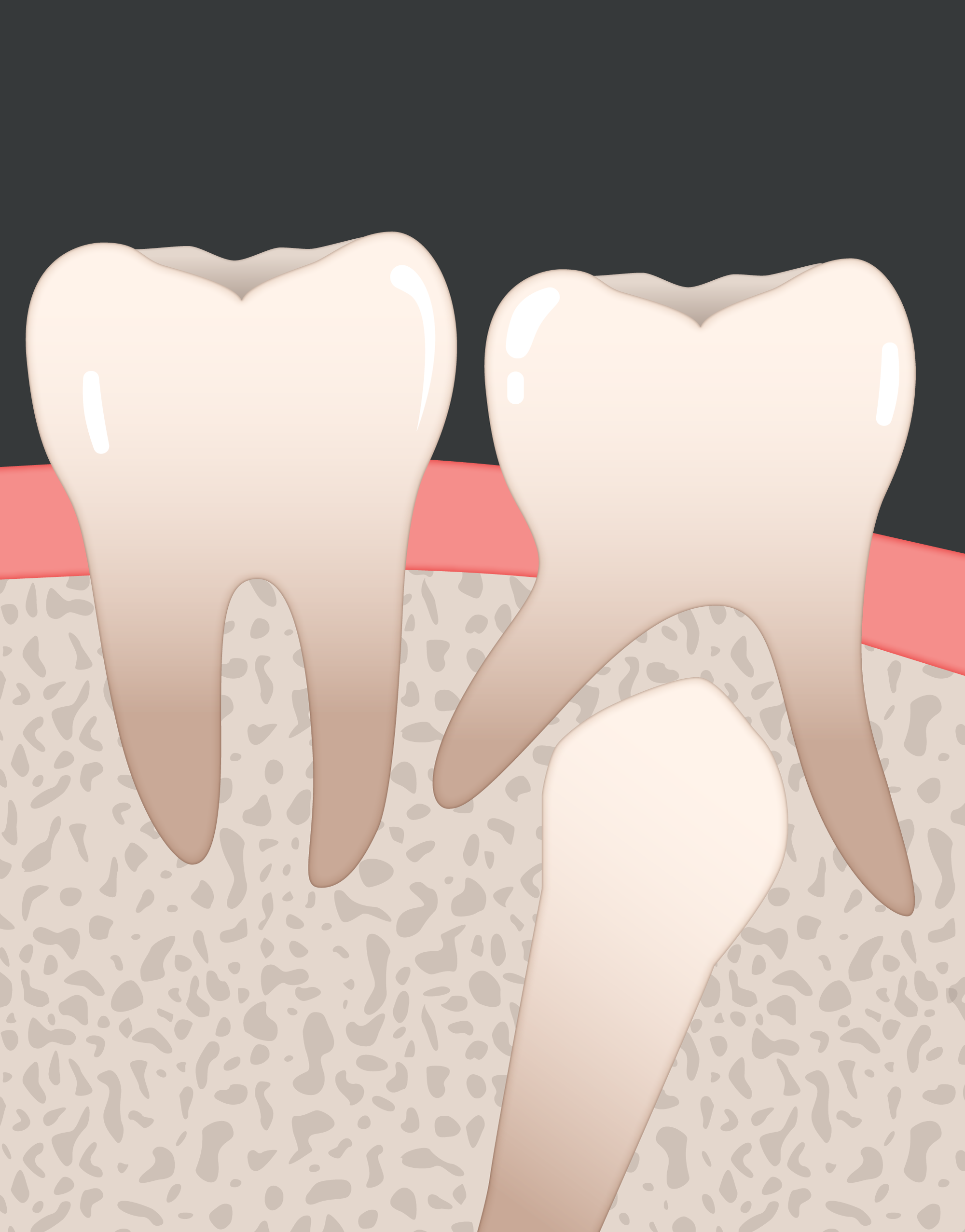 unerupted-teeth-v2.png