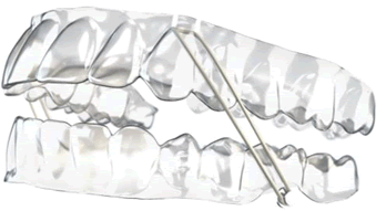 Elastics_for_Class_II.gif