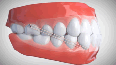 Elastics_for_Class_III.gif