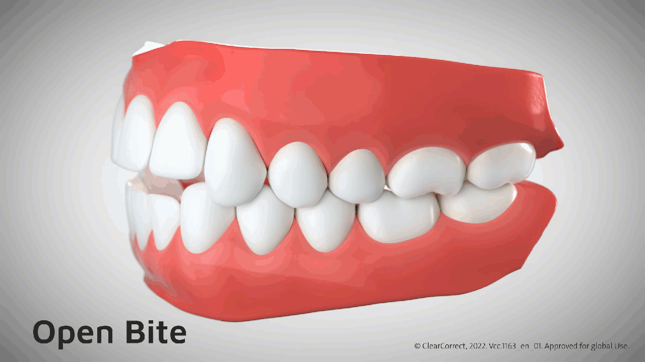 Open Bite GIF Light Grey.gif