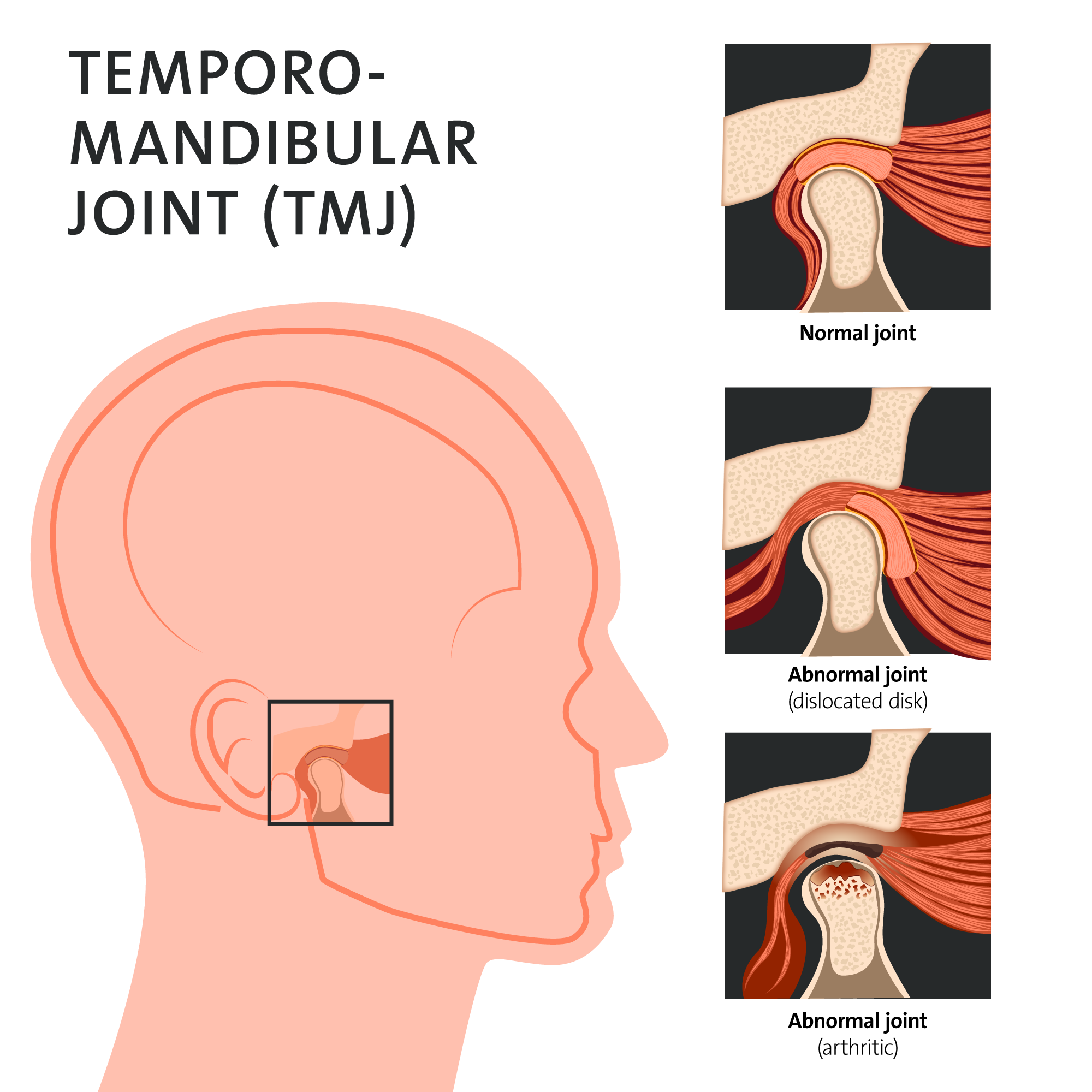 Articulação Temporomandibular - ATM - Rover Ortodontia e ATM - Cascavel