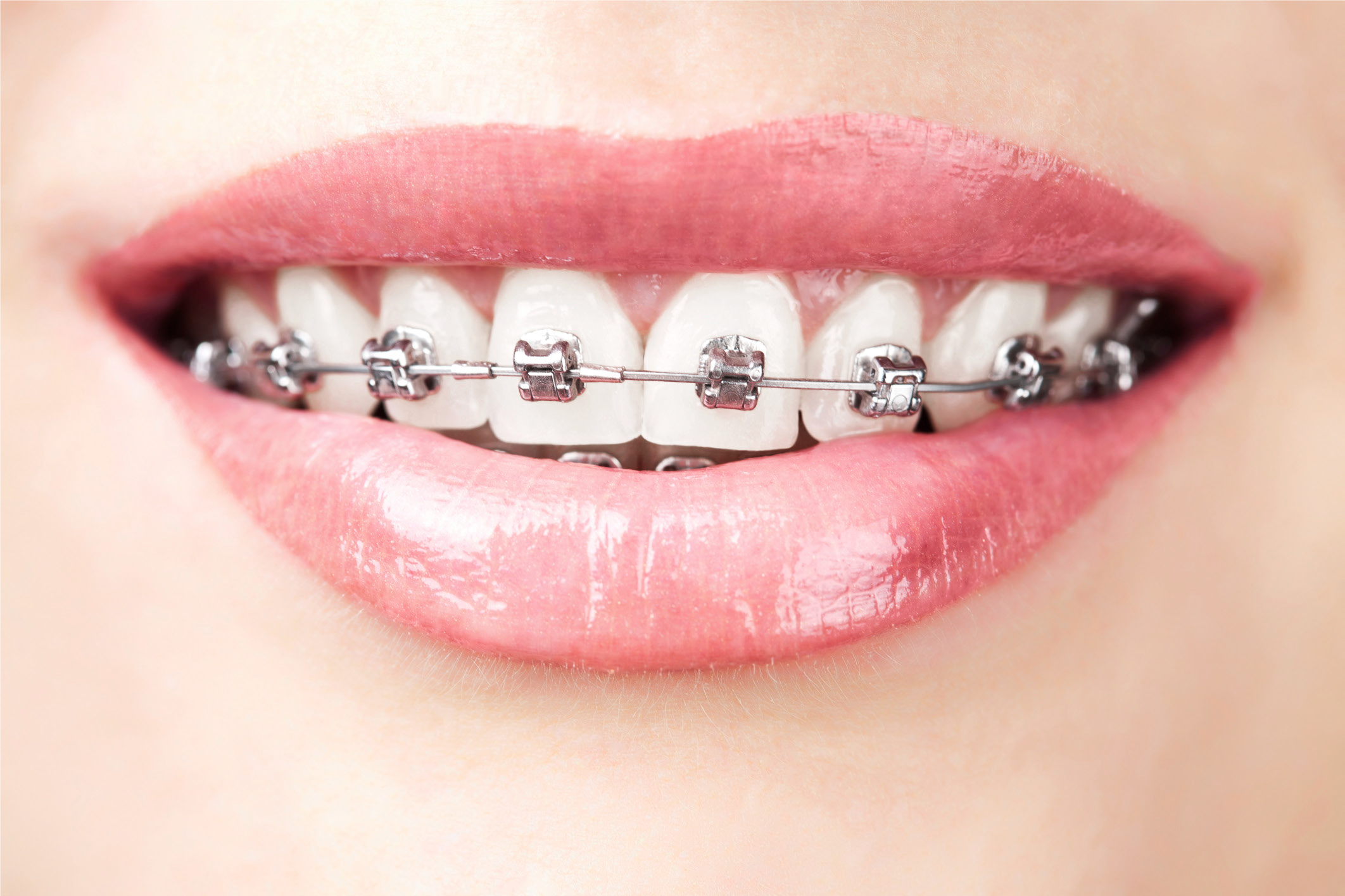 braces_2.png