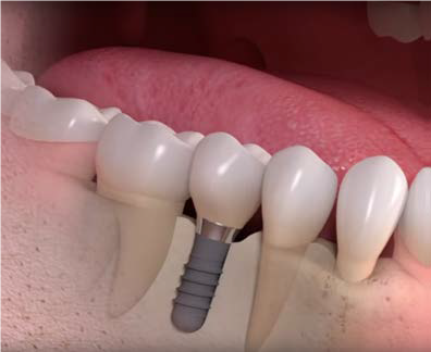 dental_implant_2.png