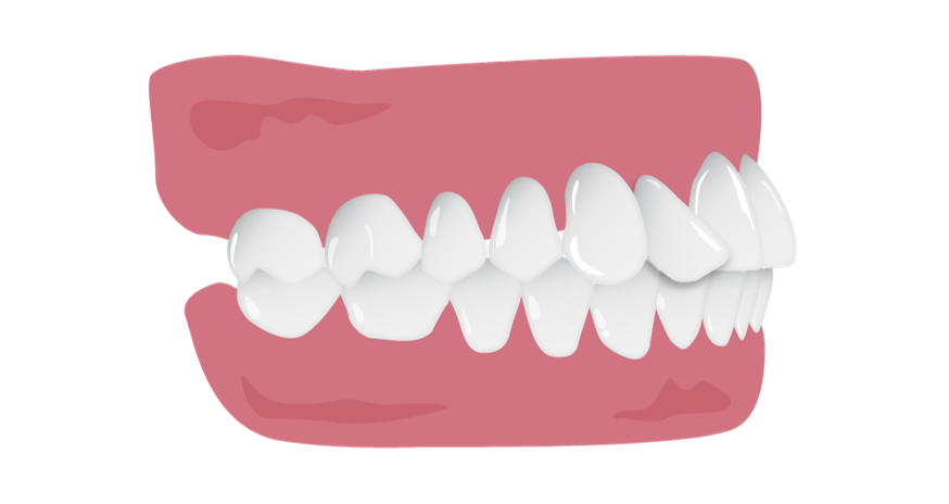 Tipped_tooth_short_borders.png