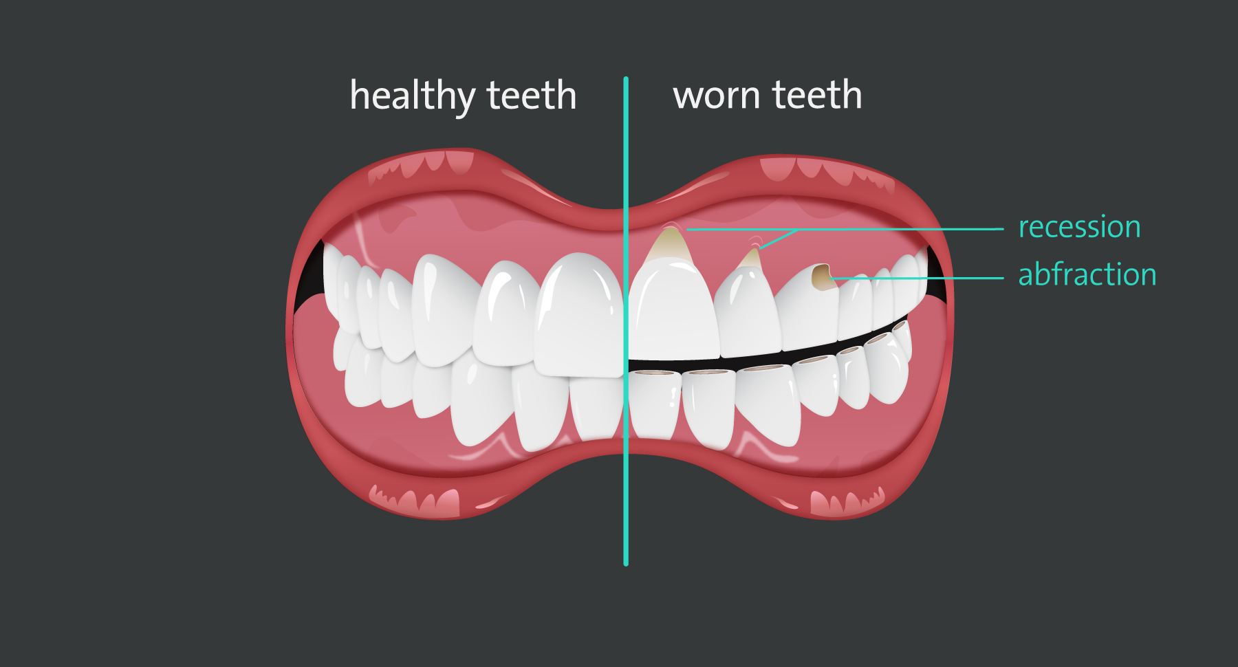 Worn-teeth-v1.png