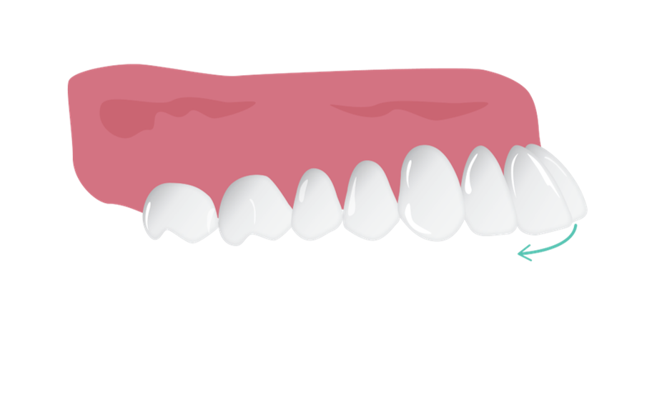 reclining_proclined_teeth.png