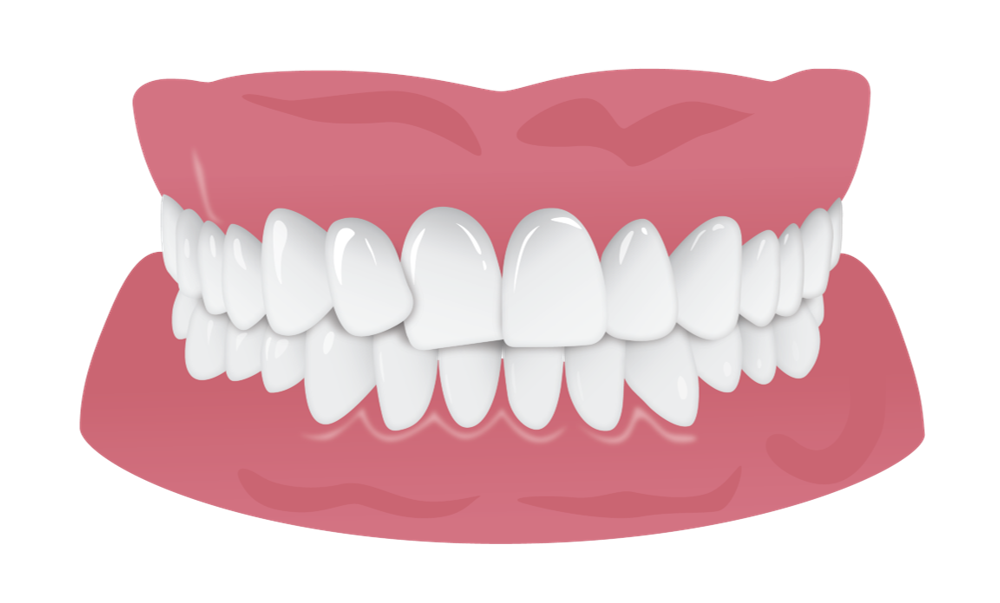 improving_tipped_teeth.png