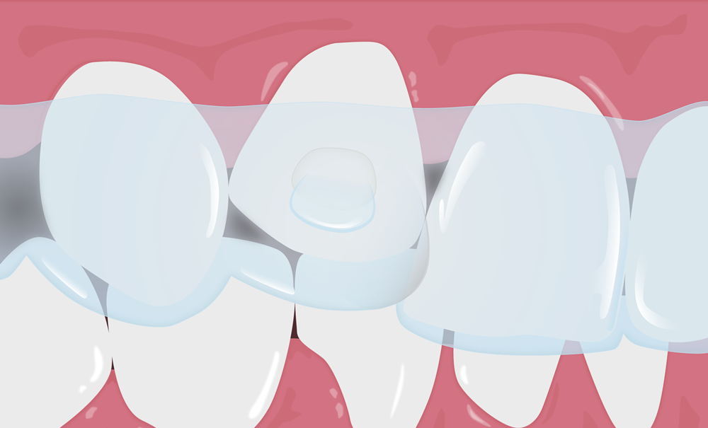 Aligners: How Should They Fit? Tips to Getting the Right Fit