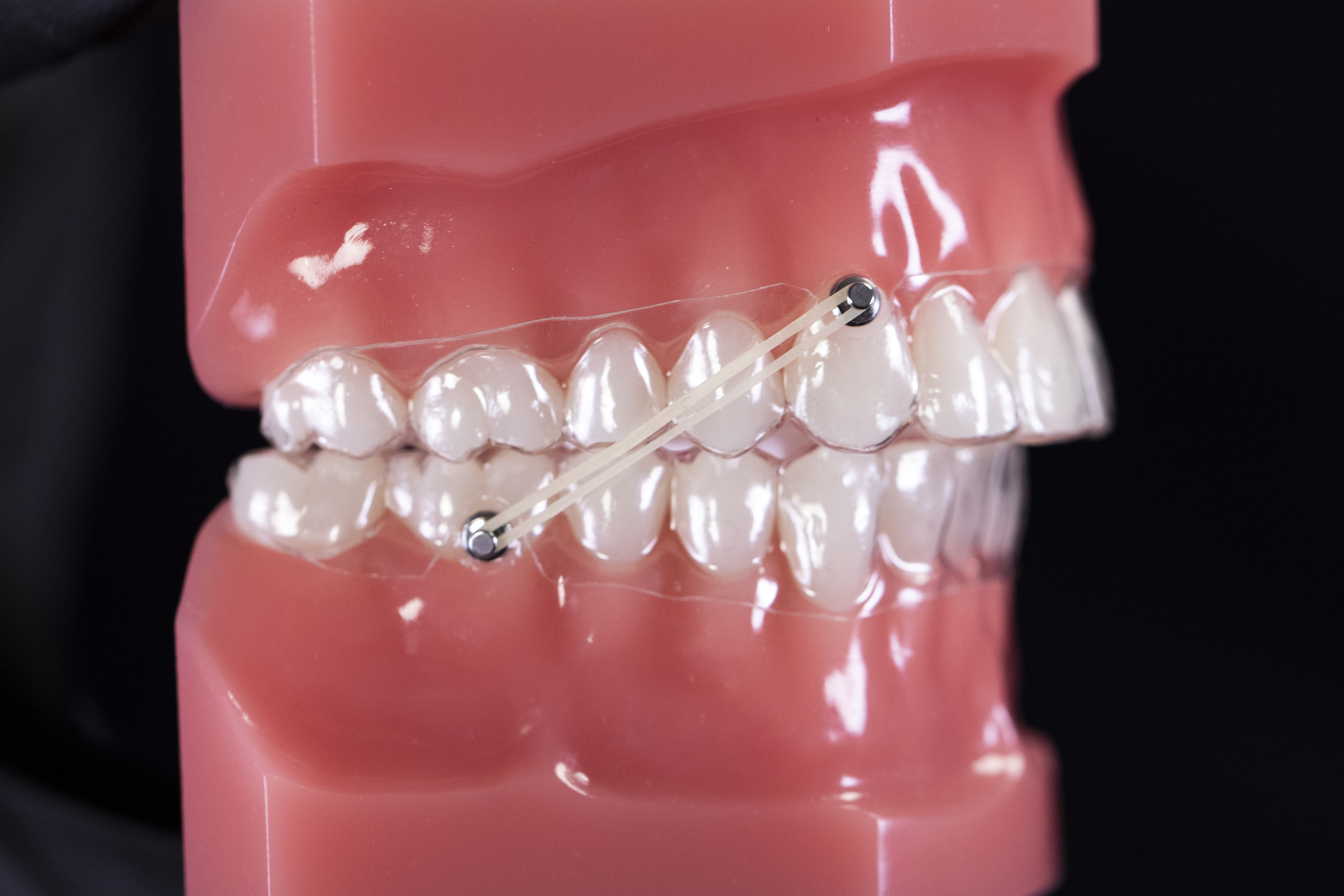 invisalign button rubber bands